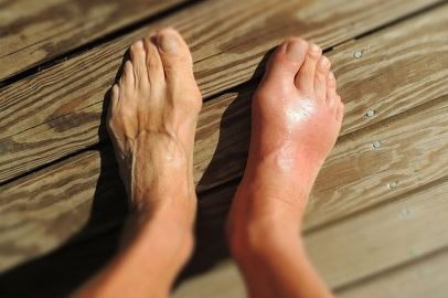 inflammation